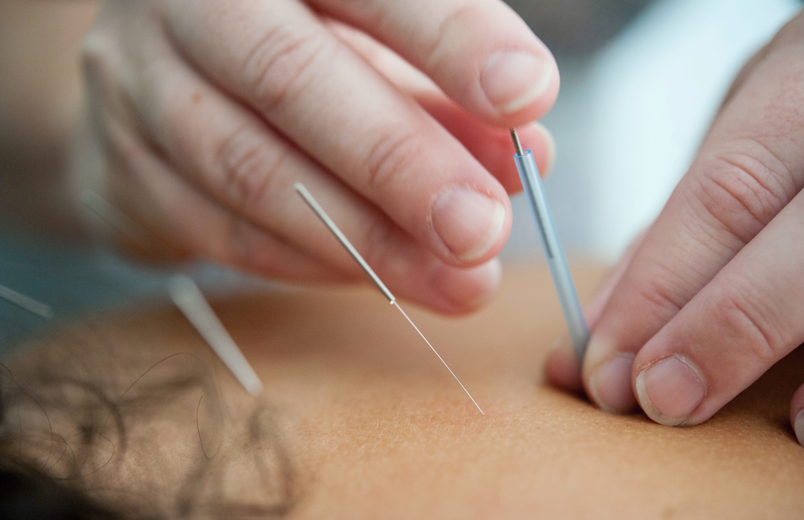 fifference of chiropractor vs acupuncture